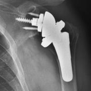 Fig 4. X-ray of a reverse shoulder replacement.