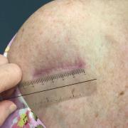 Fig 3. Healed incision after shoulder replacement.